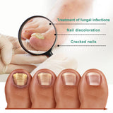 Home Bottled Nail Fungus Repair Lotion